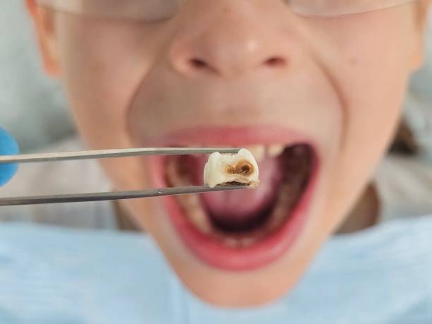 Best Emergency Tooth Extraction in Lac Du Flambeau, WI